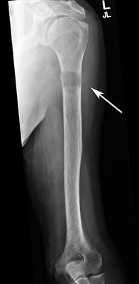 Multimodal Treatment of Bone Metastasis—A Surgical Perspective